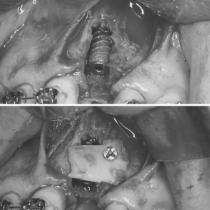 Colocación del implante dental con injerto óseo laminado