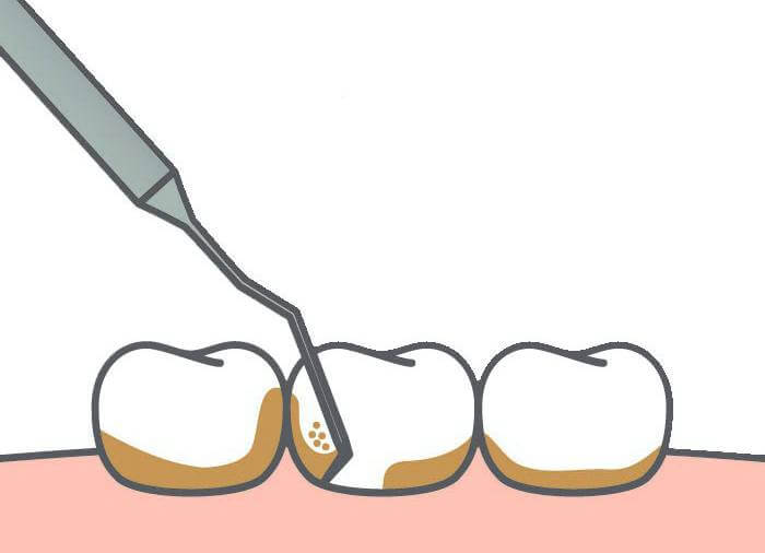raspado dental