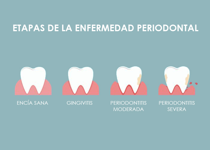 Cu les Son Las Etapas De La Enfermedad Periodontal Cu les Son Las Etapas De La Enfermedad Periodontal