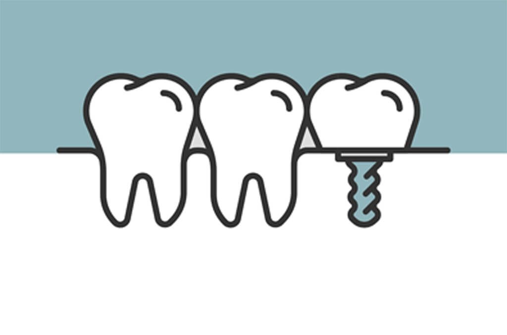 tipos implantes dentales