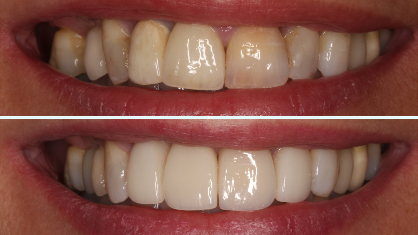 Tratamiento antes y despues del fracaso de una endodoncia