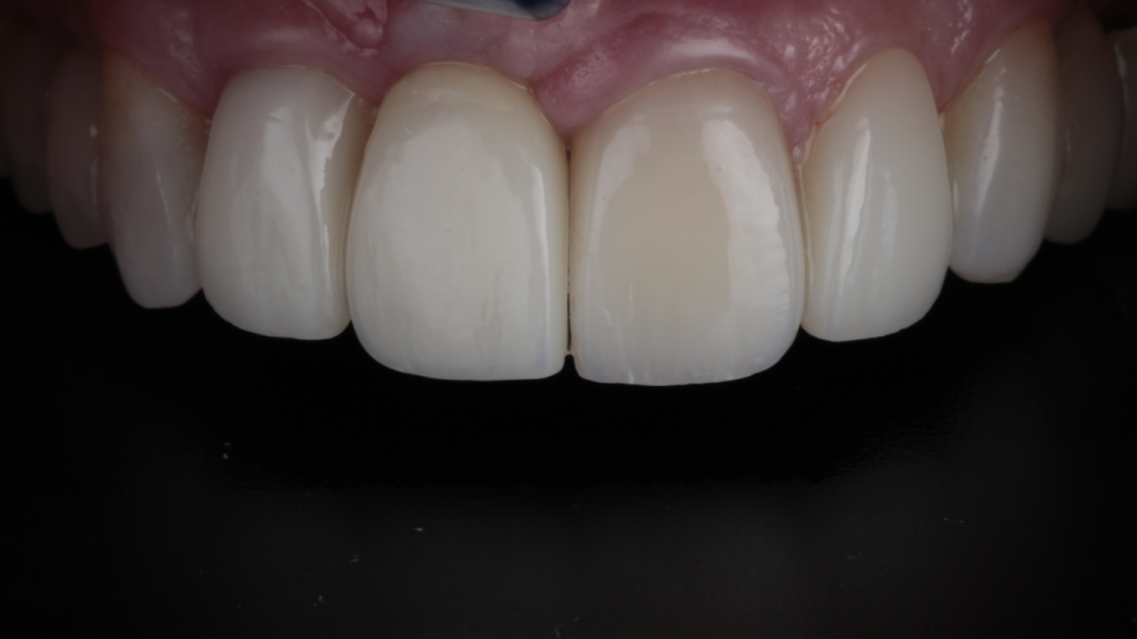 Resultado estetico final en sector anterior con carillas de porcelana tras fracaso de una endodoncia
