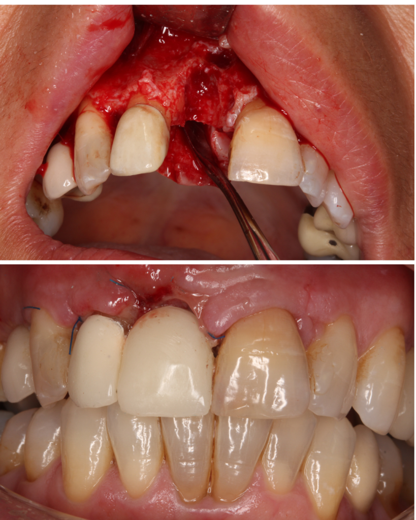Extraccion incisivo central y protesis provisional