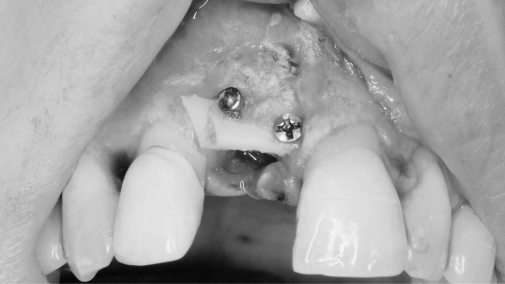 Injerto oseo dental tecnica khoury
