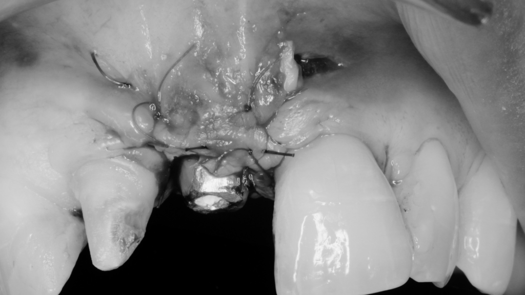 Implante dental en incisivo central tras fracaso de una endodoncia