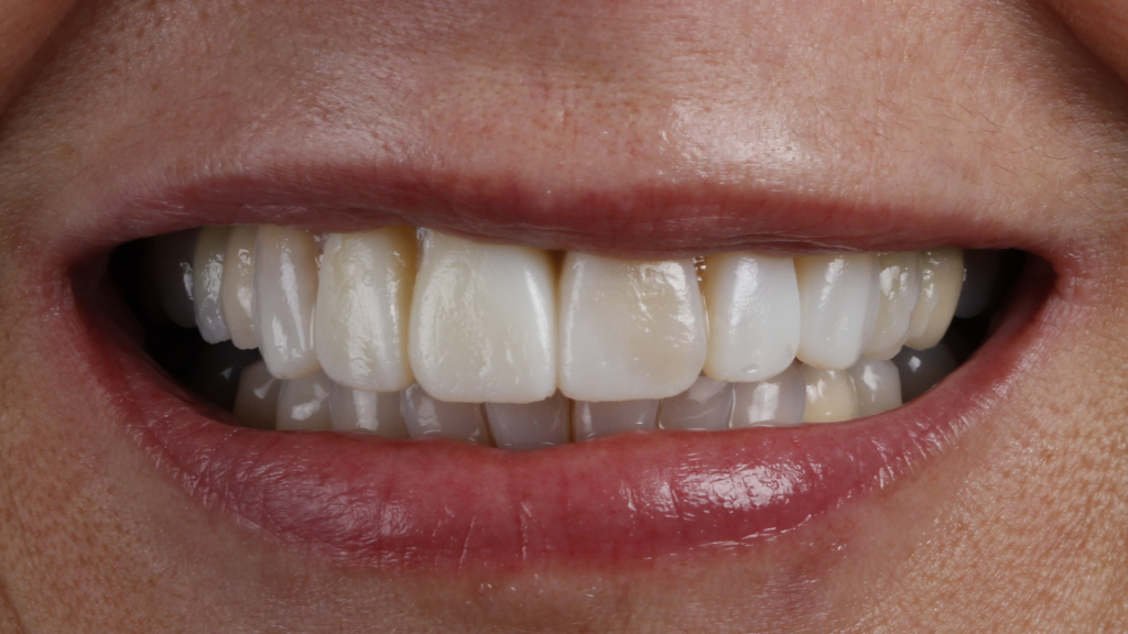 Mockup conforme a diseño de sonrisa